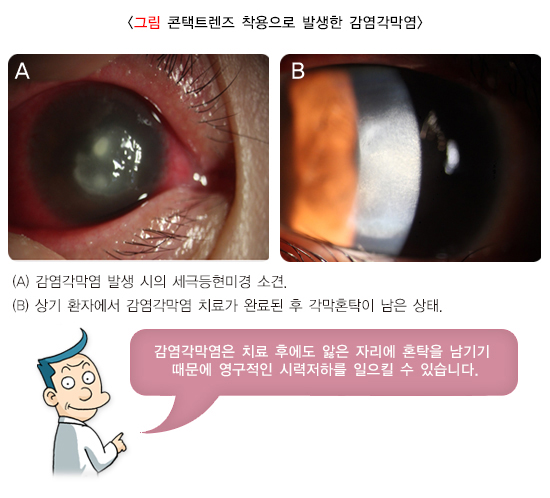 콘택트렌즈 착용으로 발생한 감염각막염