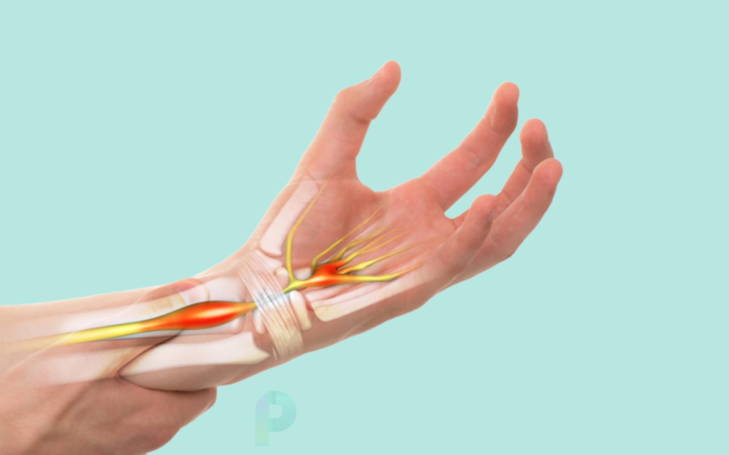손목 터널 증후군 증상, 치료 방법 및 예방법