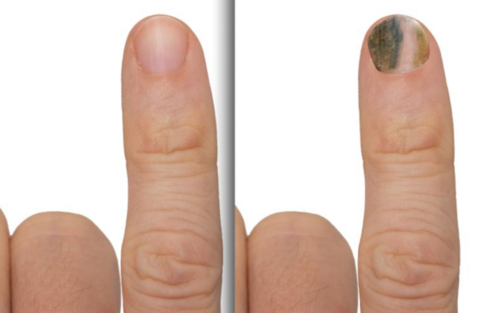 손톱, 발톱 멍 생겼을 때 응급처치 및 치료 방법은?